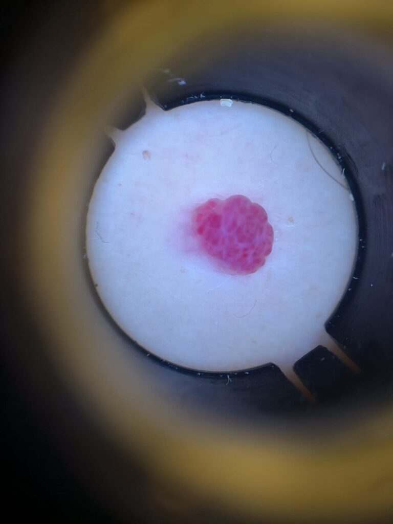 imagen de un angioma