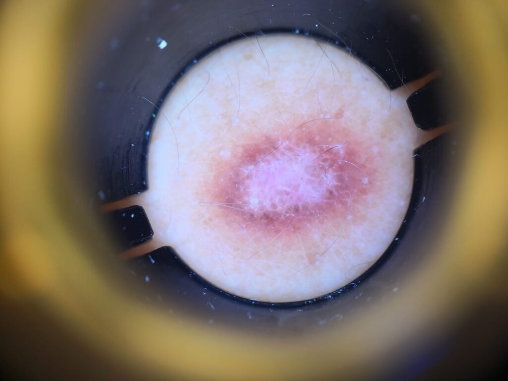 imagen de un dermatofibra