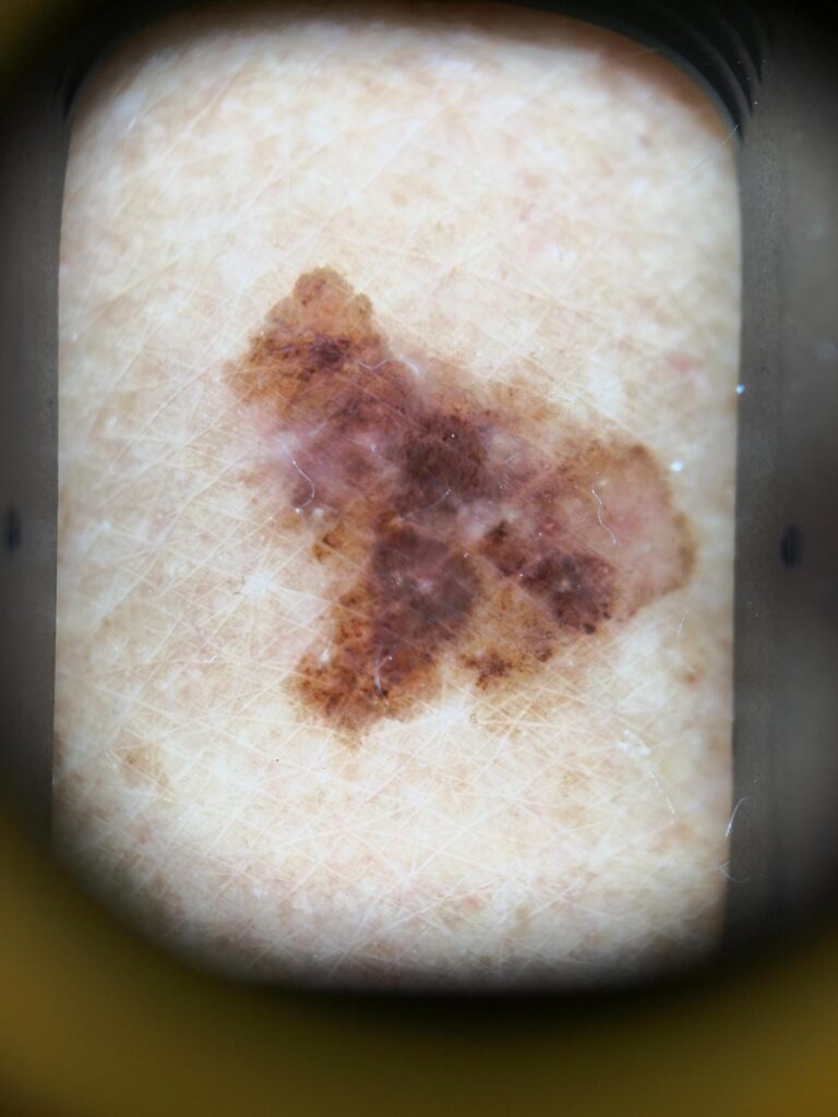 imagen de un melanoma