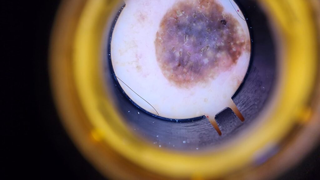 imagen de una queratosis seborreica
